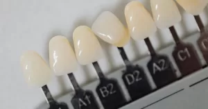 faceta-dentes-materiais-2.jpg