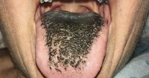 lingua-preta-pilosa.jpg