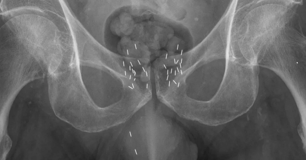 braquiterapia-radioterapia-interna.jpg