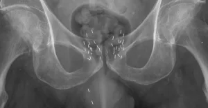 braquiterapia-radioterapia-interna.jpg